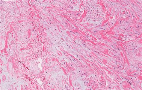 desmoplastic fibroblastoma pathology outlines